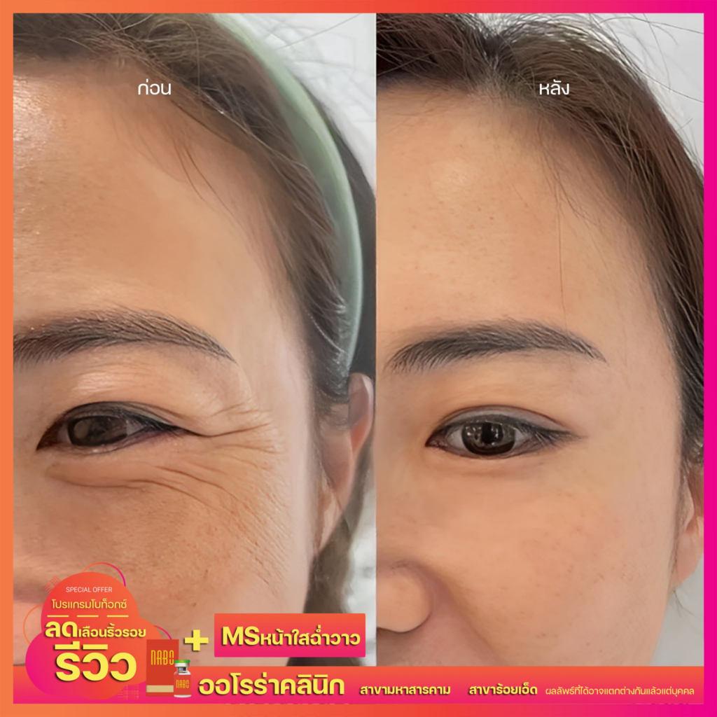 รีวิวคลินิกเสริมความงาม ร้อยเอ็ดที่ AURORA CLINIC