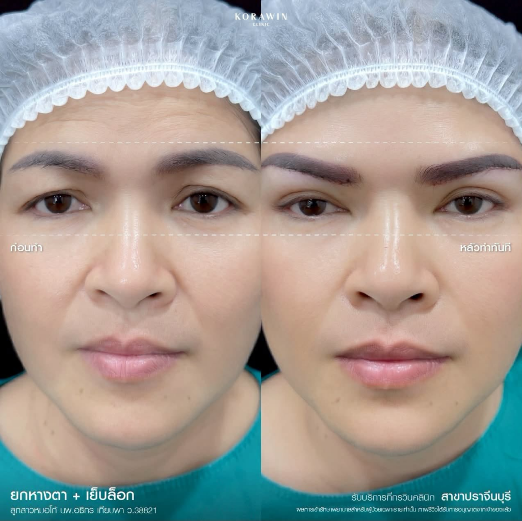 รีวิวคลินิกเสริมความงาม หนองคาย กรวินคลินิก