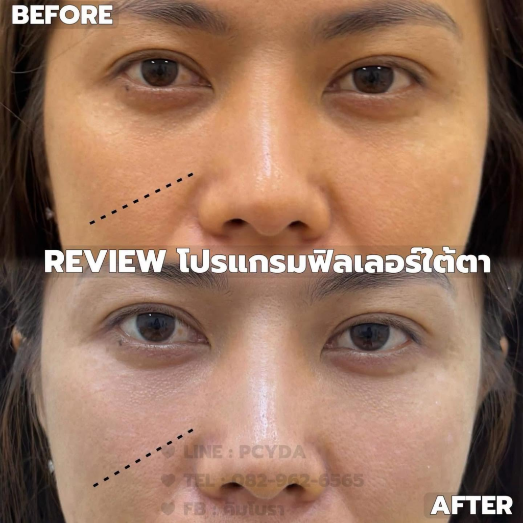 รีวิวคลินิกเสริมความงาม ร้อยเอ็ดที่ PEARPAUL CLINIC