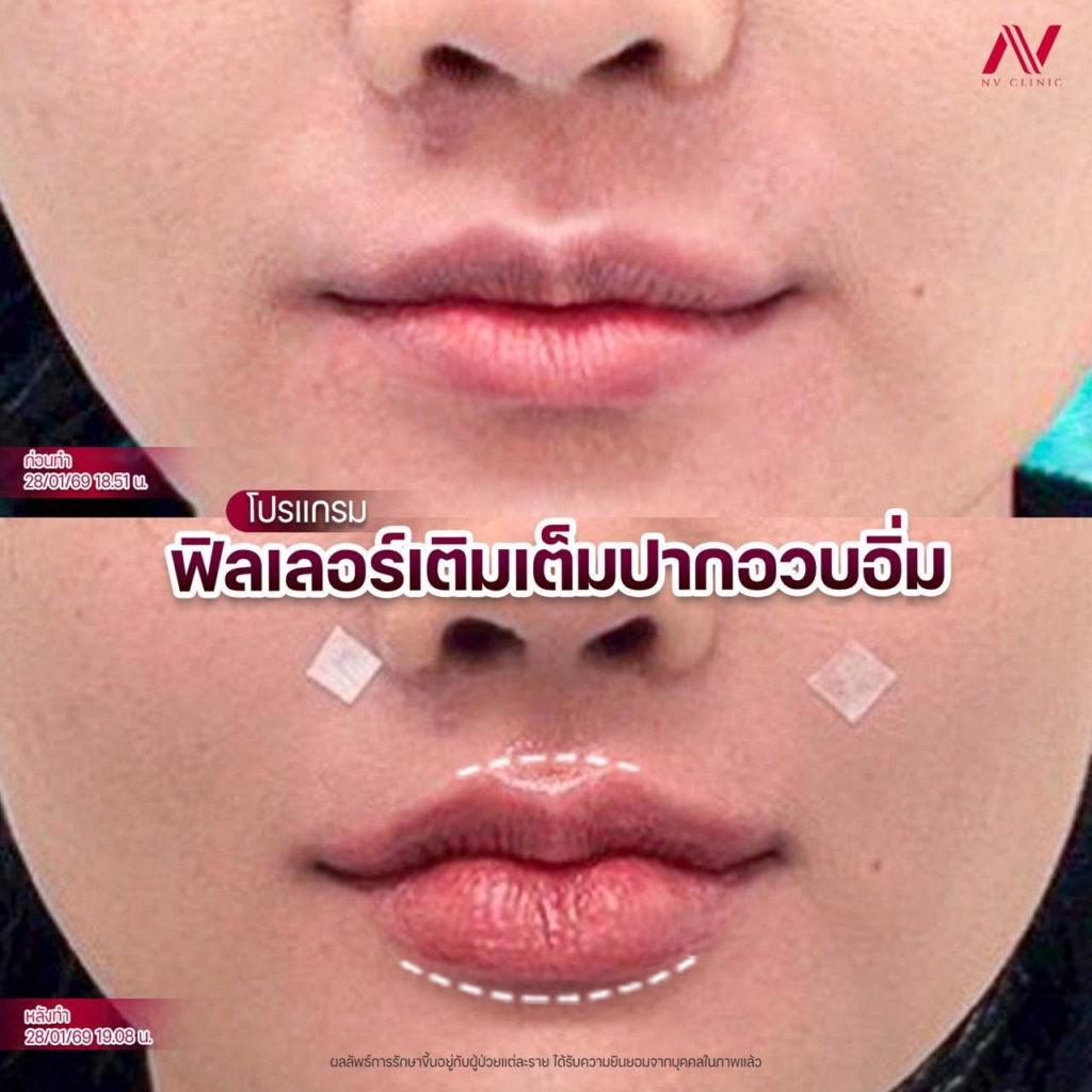 รีวิวคลินิกเสริมความงาม ร้อยเอ็ดที่ NV clinic