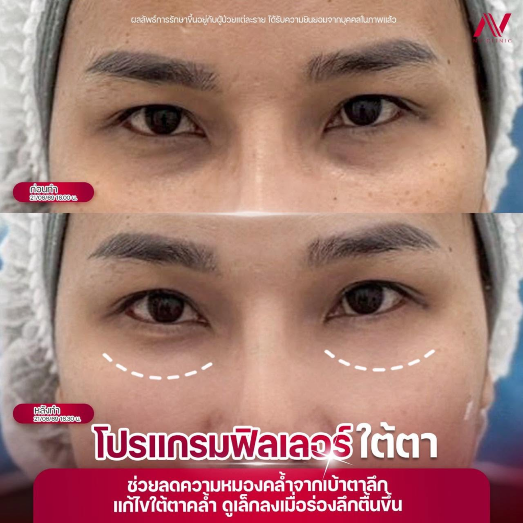 รีวิวคลินิกเสริมความงาม ร้อยเอ็ดที่ NV clinic