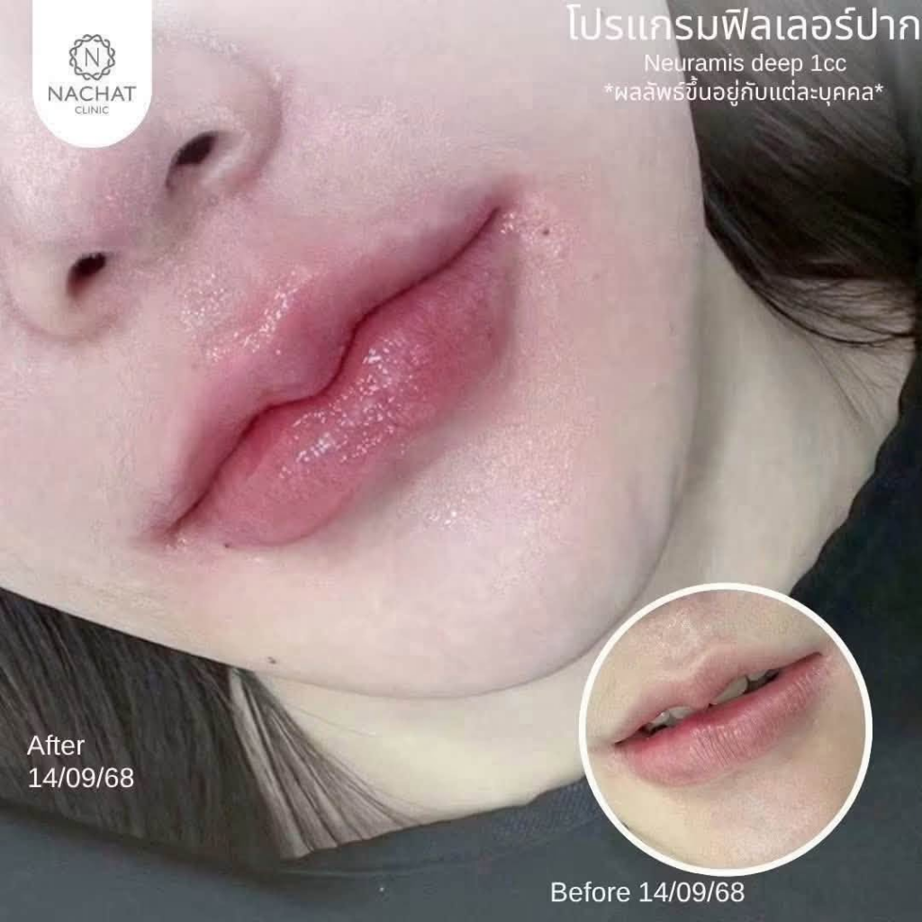 รีวิวคลินิกเสริมความงาม ร้อยเอ็ดที่ Nachat Clinic