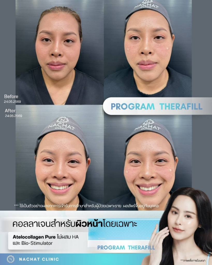 รีวิวคลินิกเสริมความงาม ร้อยเอ็ดที่ Nachat Clinic