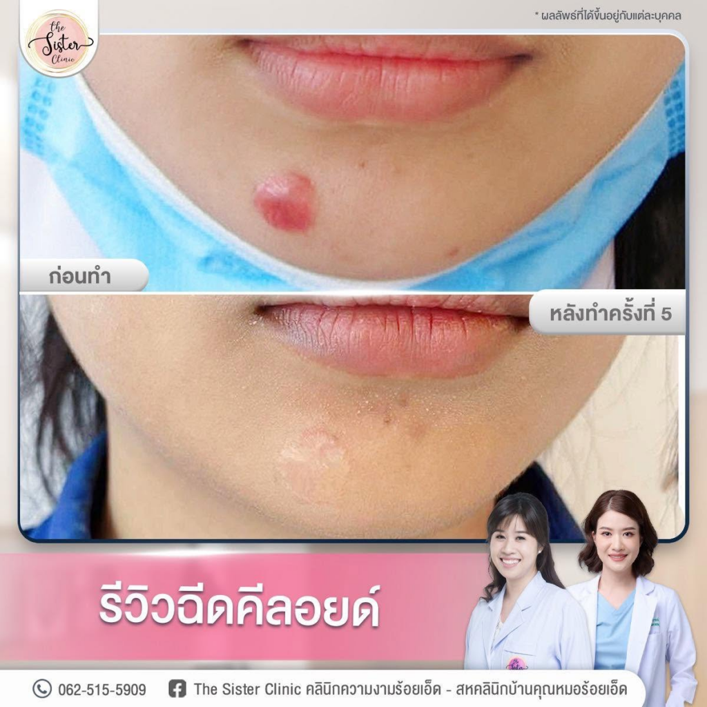 รีวิวคลินิกเสริมความงาม ร้อยเอ็ดที่ The Sister Clinic