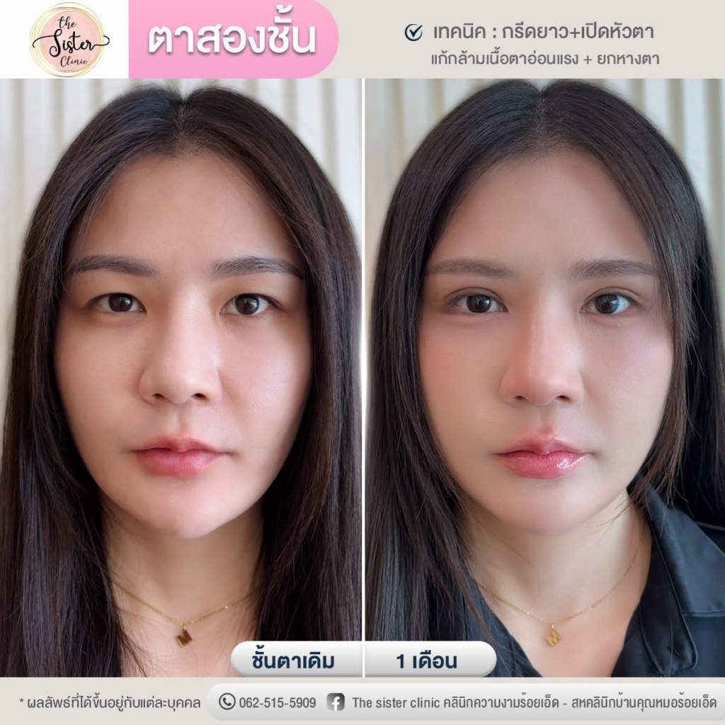 รีวิวคลินิกเสริมความงาม ร้อยเอ็ดที่ The Sister Clinic