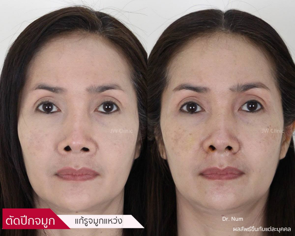 รีวิวคลินิกเสริมความงาม หนองคาย JW Clinic