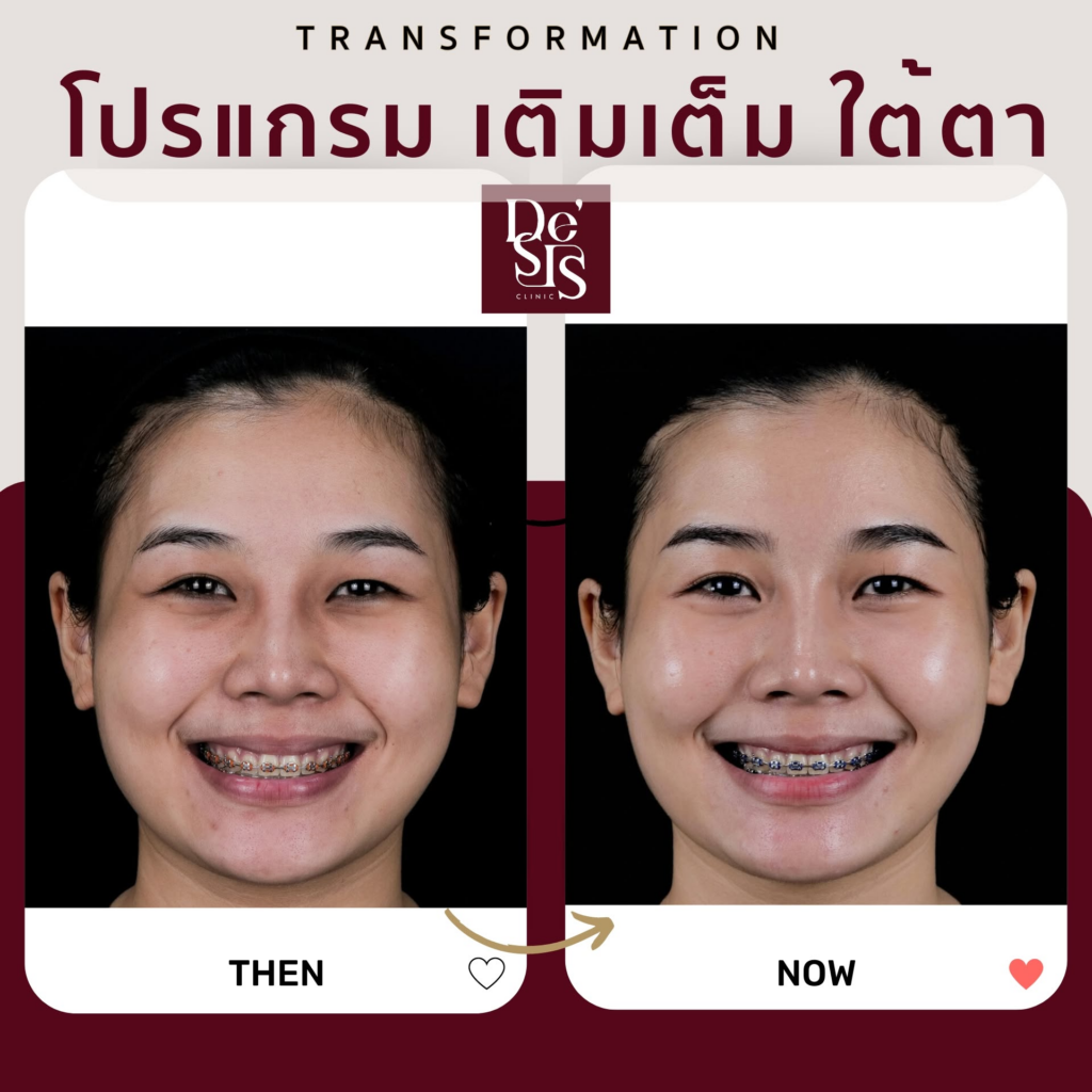 รีวิวคลินิกเสริมความงาม หนองคาย De'SIS Clinic