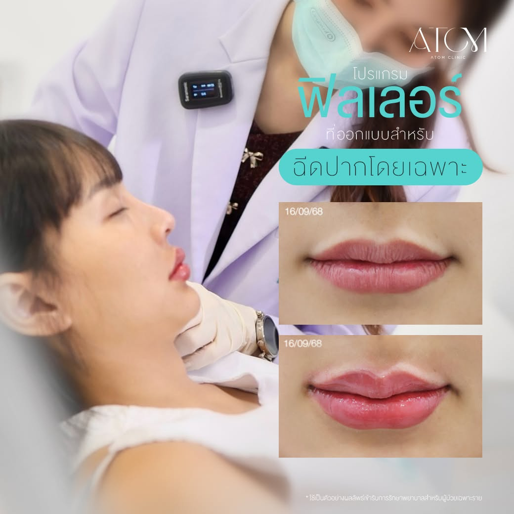 รีวิวฉีดฟิลเลอร์ปากที่ Atom Clinic