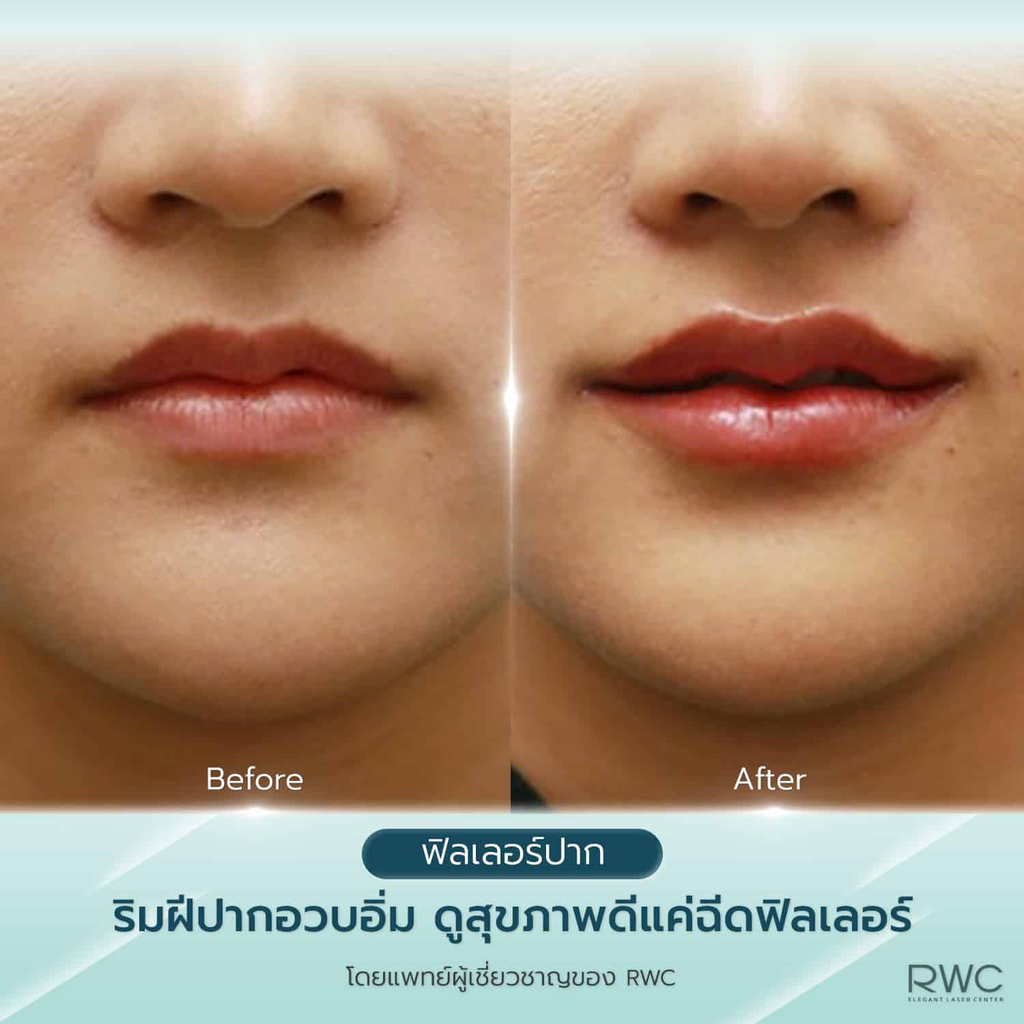 รีวิวฉีดฟิลเลอร์ปากที่ RWC Clinic