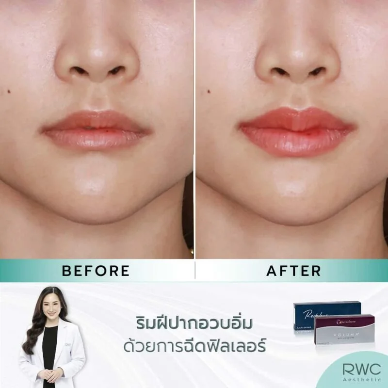 รีวิวฉีดฟิลเลอร์ปากที่ RWC Clinic