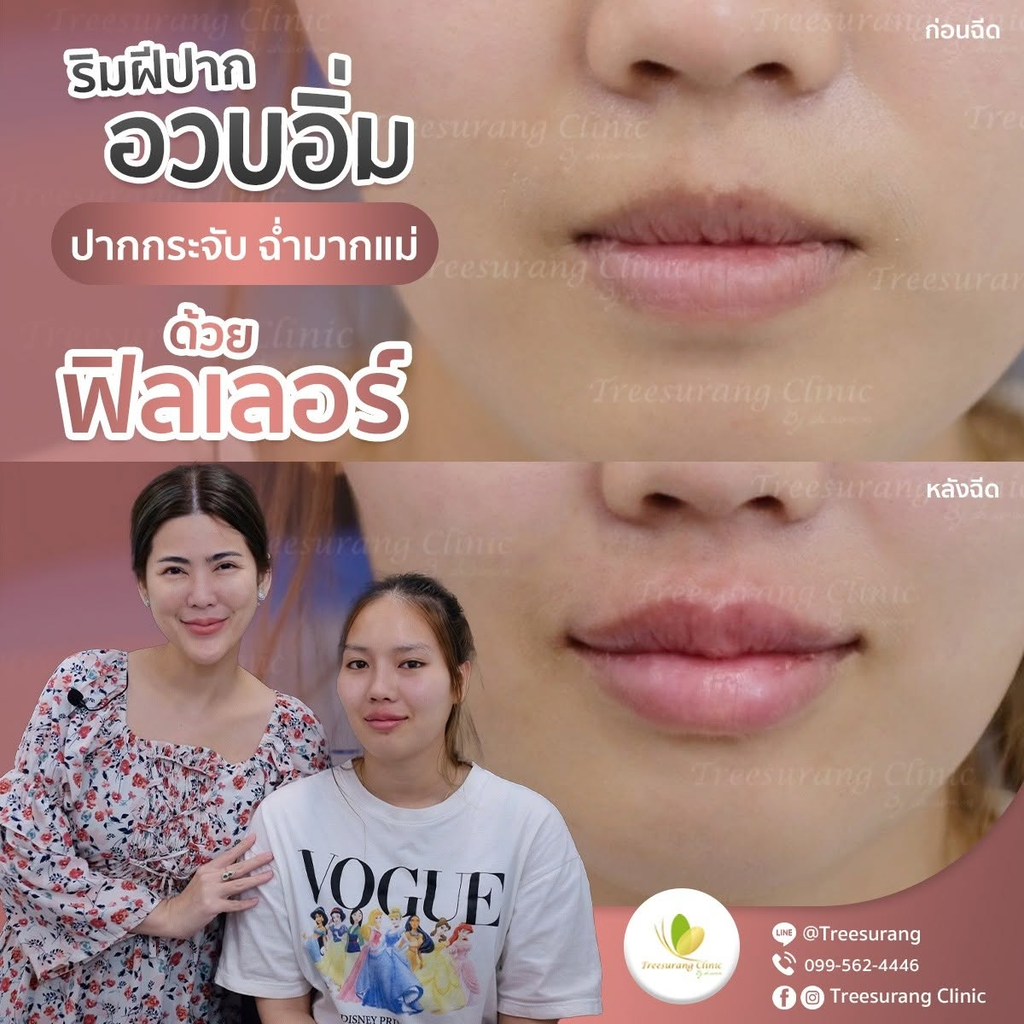 รีวิวฉีดฟิลเลอร์ปากที่ Treesurang Clinic