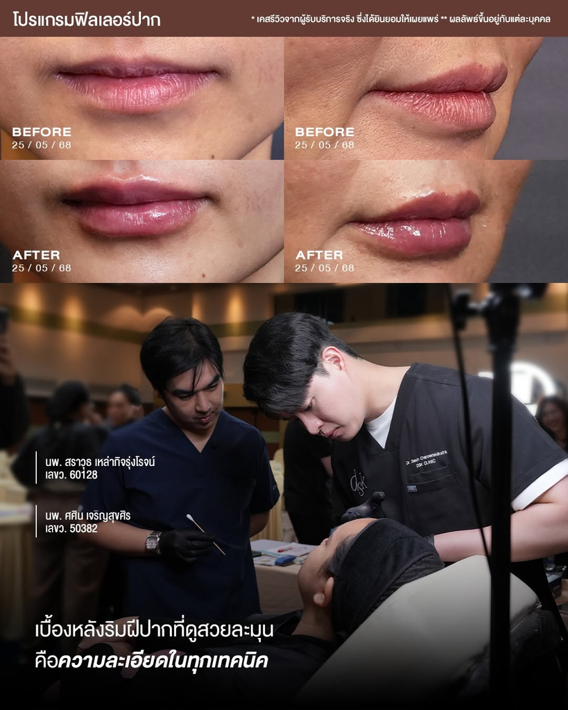 รีวิวฉีดฟิลเลอร์ปากที่ DKS Clinic
