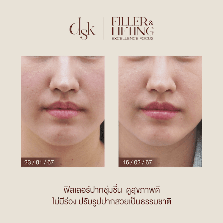 รีวิวฉีดฟิลเลอร์ปากที่ DKS Clinic