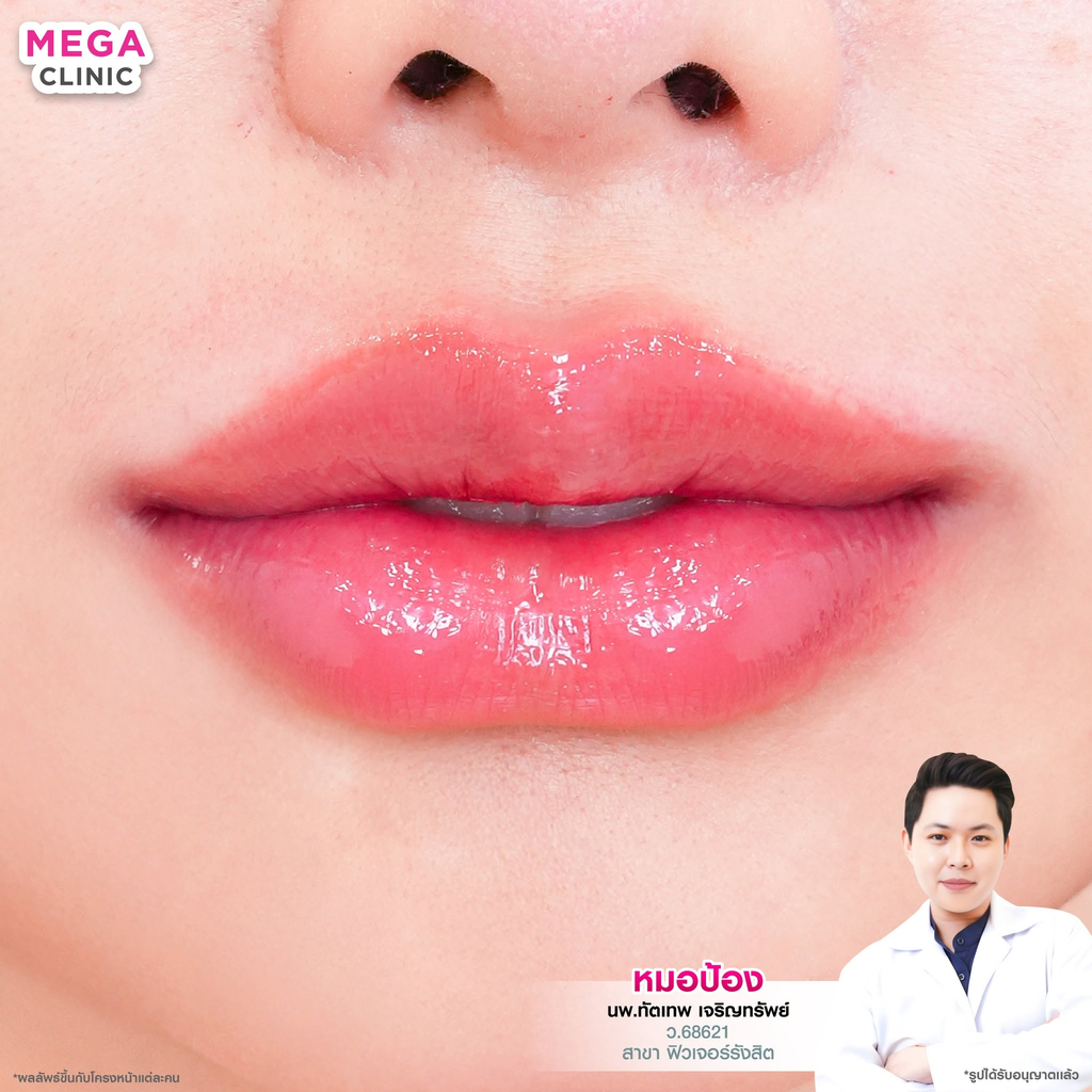 รีวิวฉีดฟิลเลอร์ปากที่ Mega Clinic
