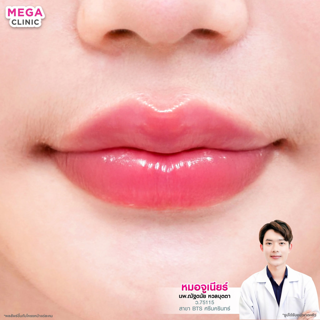 รีวิวฉีดฟิลเลอร์ปากที่ Mega Clinic
