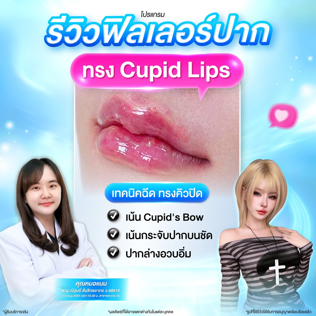 รีวิวฉีดฟิลเลอร์ปากที่ LBC Clinic