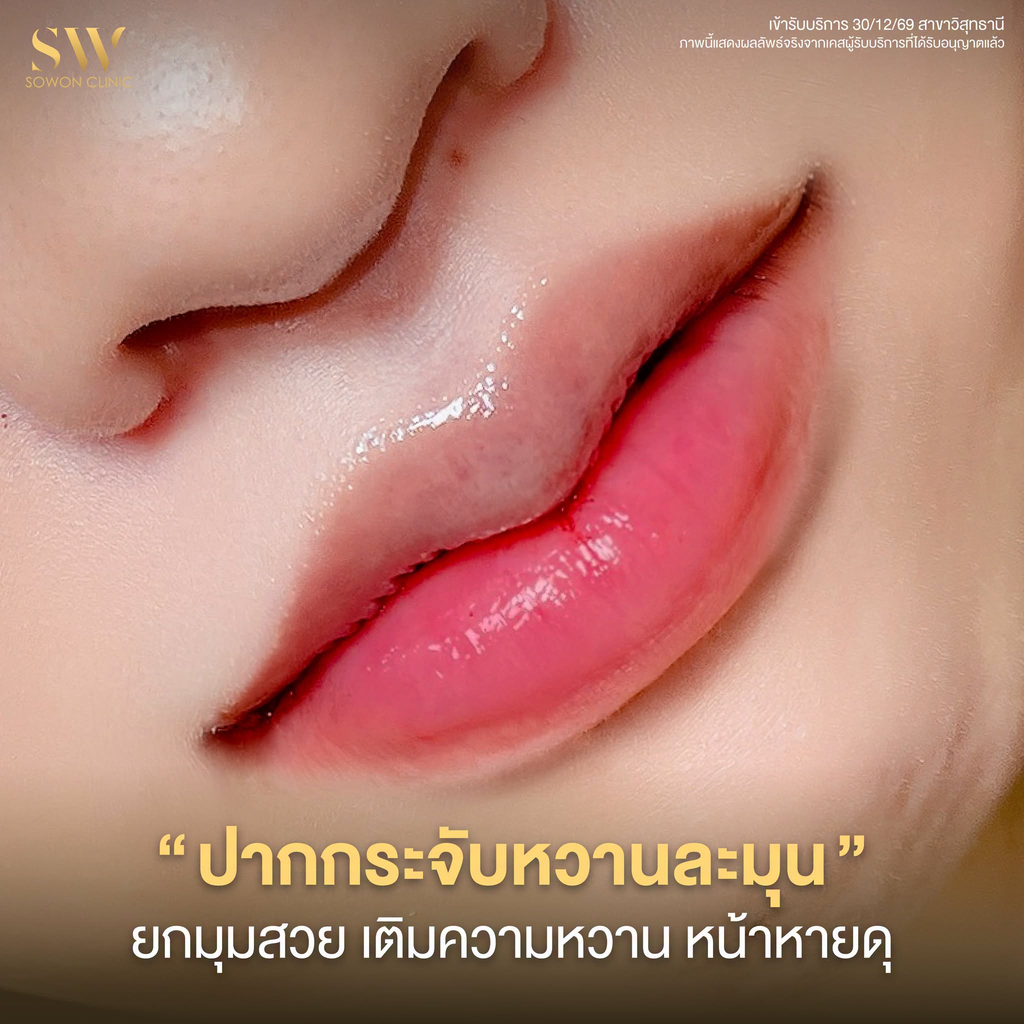 รีวิวฉีดฟิลเลอร์ปากที่ Sowon Clinic