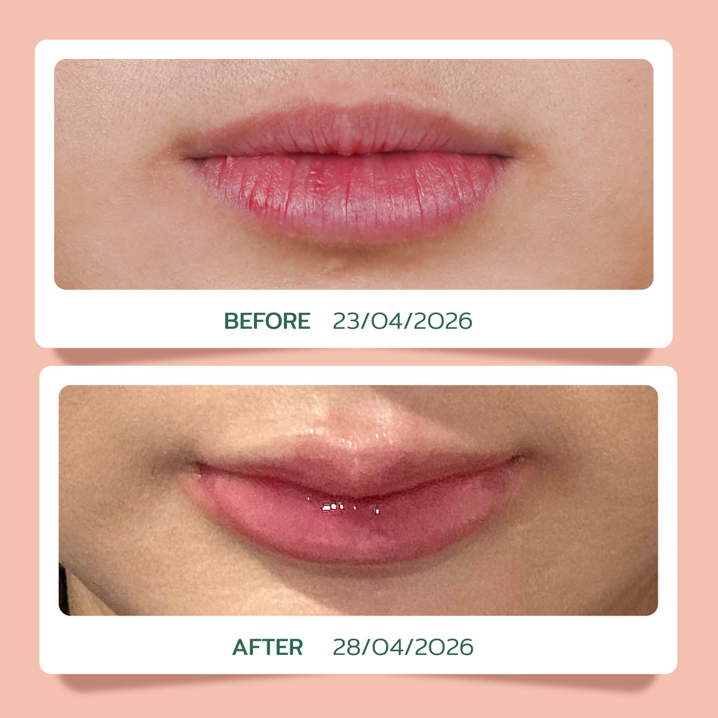 รีวิวฉีดฟิลเลอร์ปากที่ Classy Clinic