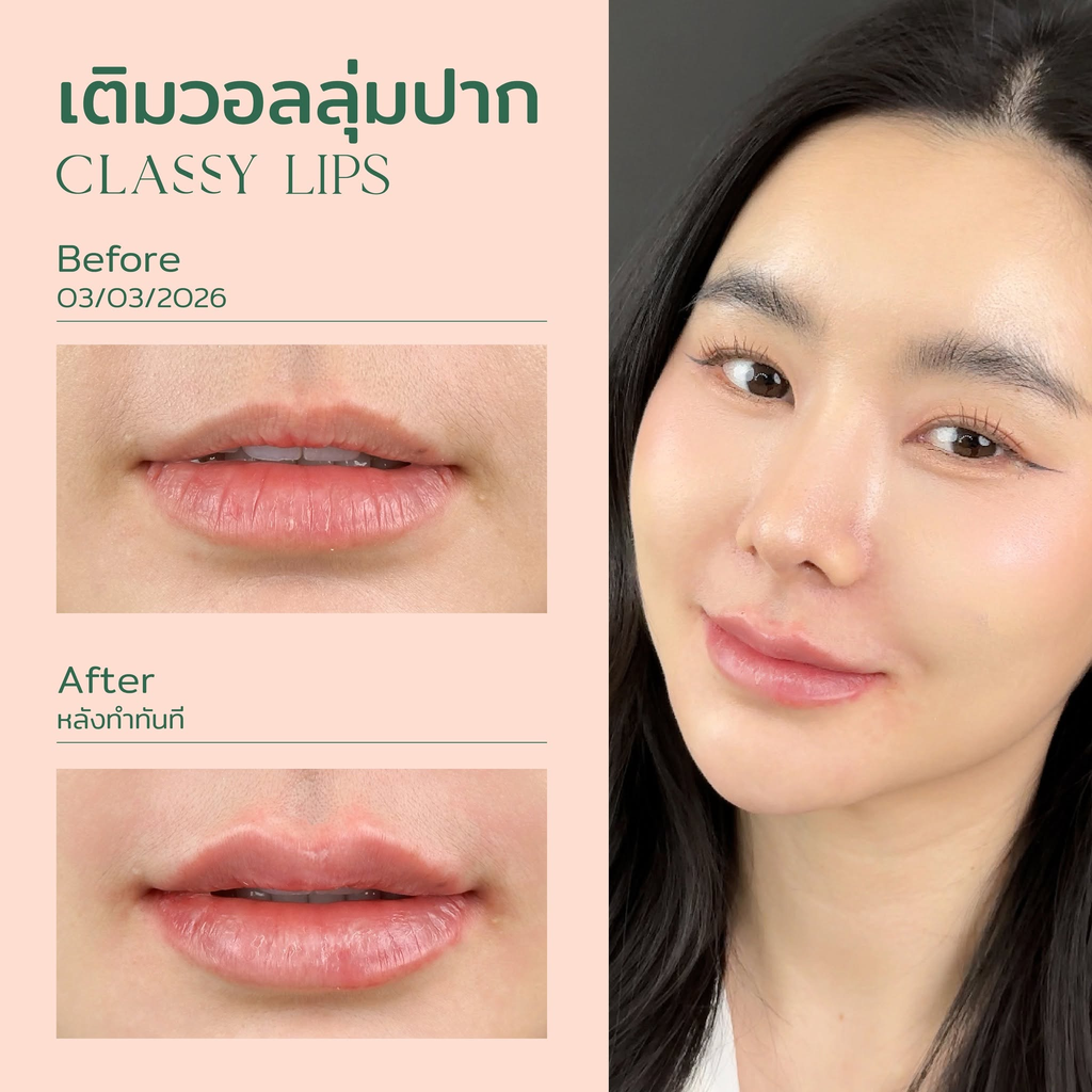 รีวิวฉีดฟิลเลอร์ปากที่ Classy Clinic