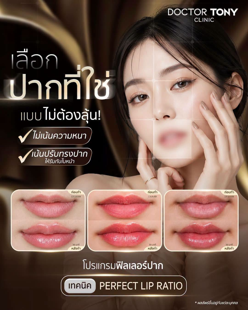 รีวิวฉีดฟิลเลอร์ปากที่ Doctor Tony Medical Center