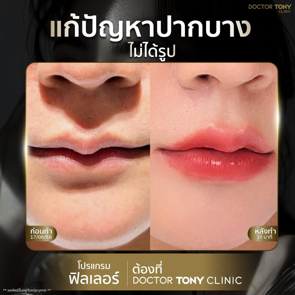รีวิวฉีดฟิลเลอร์ปากที่ Doctor Tony Medical Center