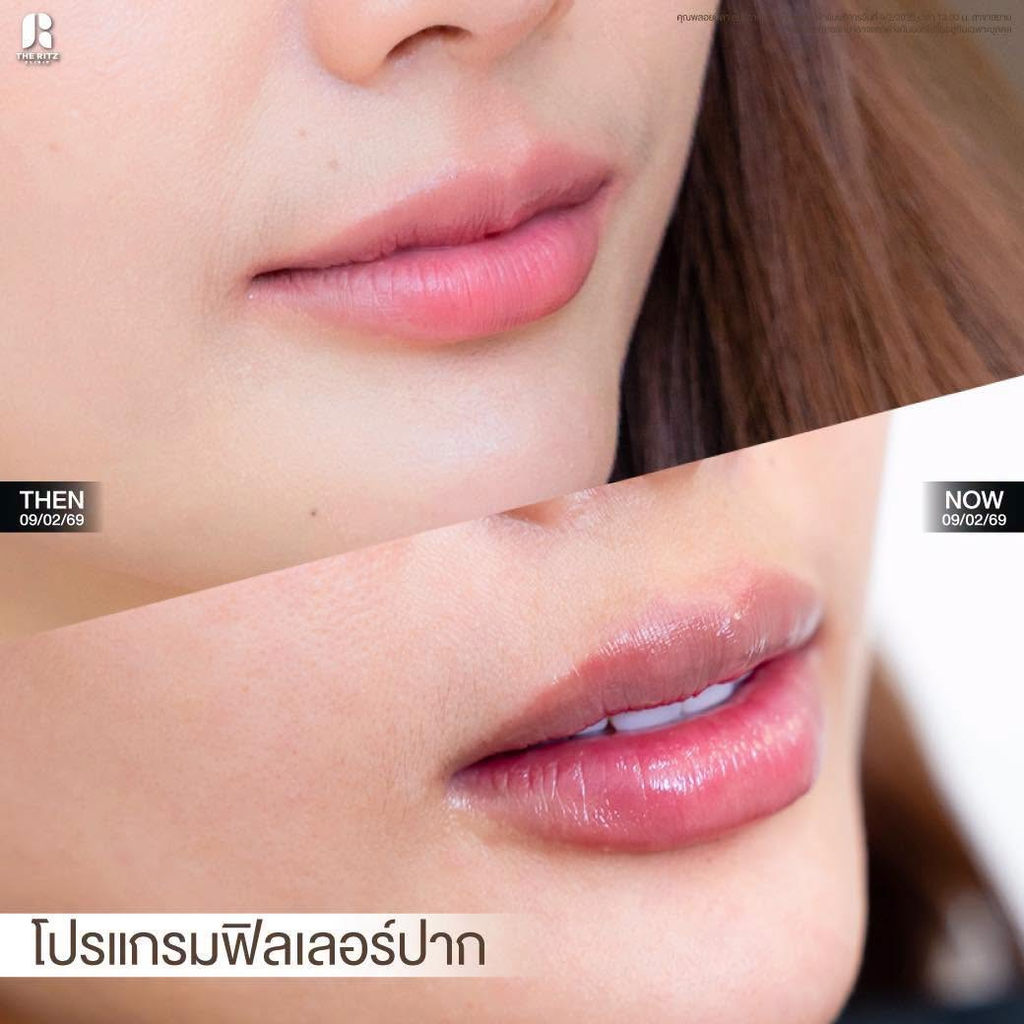 รีวิวฉีดฟิลเลอร์ปากที่ The Ritz Clinic