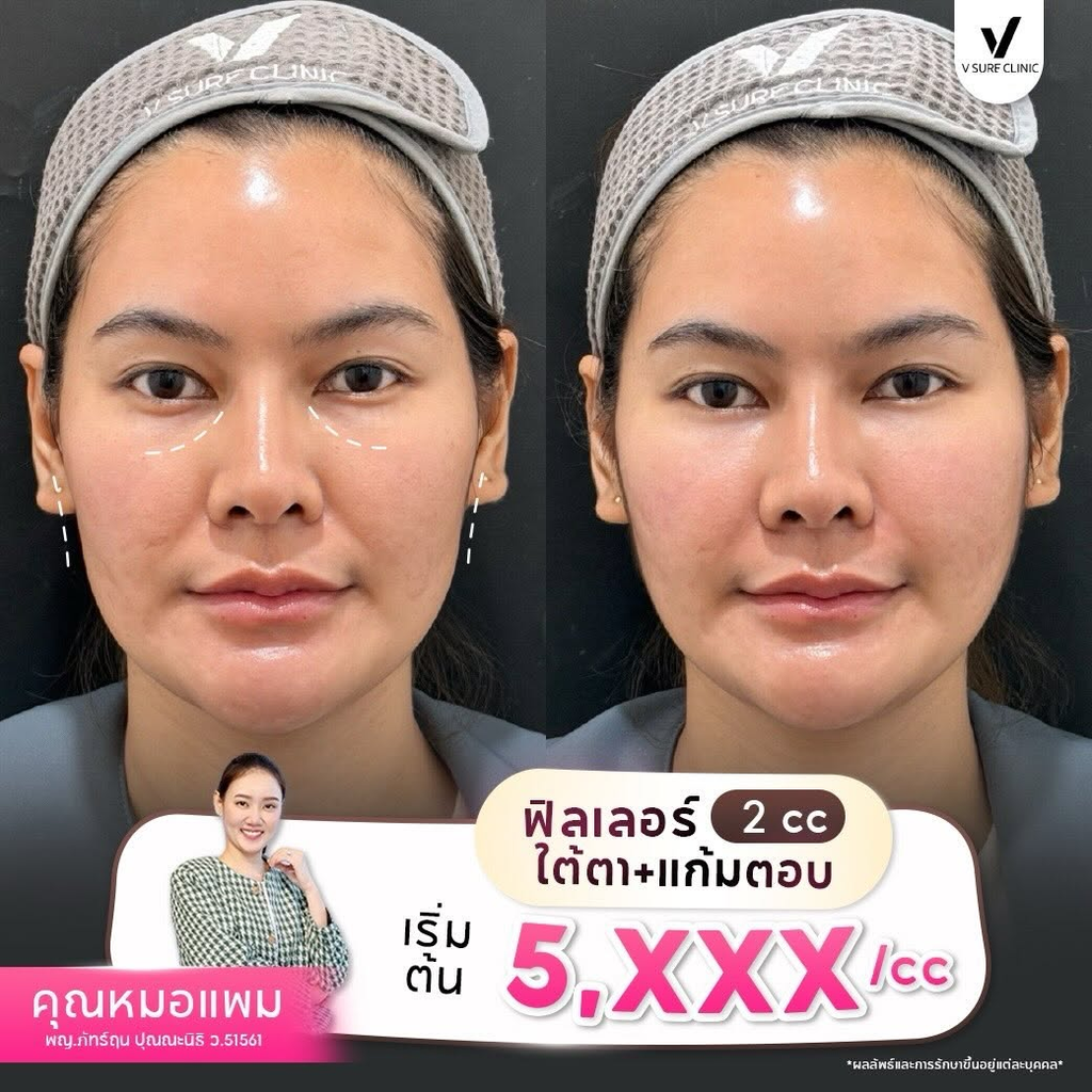 รีวิวฉีดฟิลเลอร์โคราชที่ V Sure Clinic
