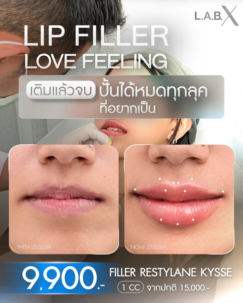 รีวิวฉีดฟิลเลอร์ปากที่ LabX Clinic