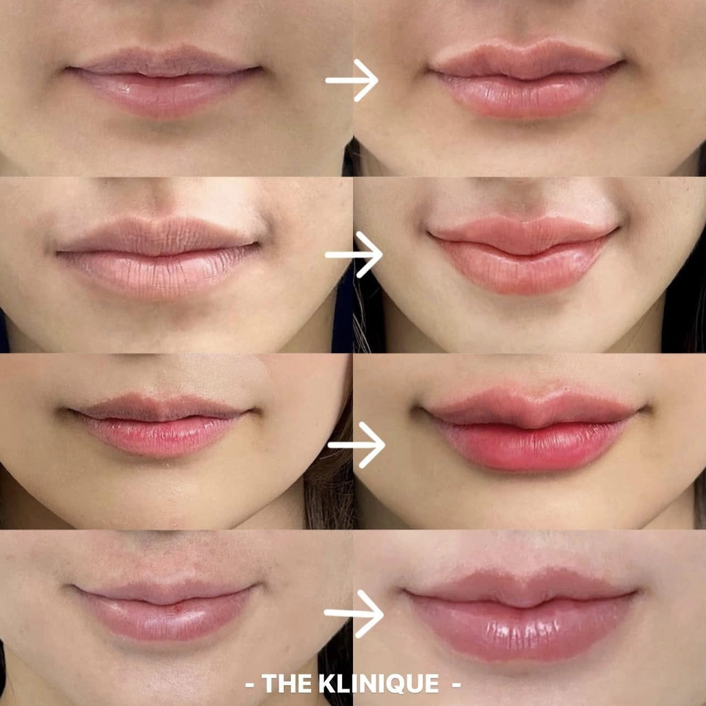 รีวิวฉีดฟิลเลอร์ปากที่ THE KLINIQUE