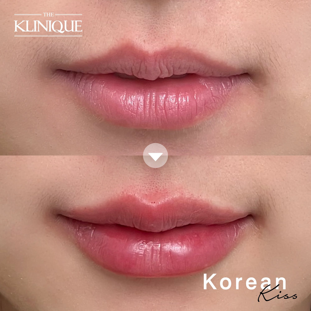 รีวิวฉีดฟิลเลอร์ปากที่ THE KLINIQUE