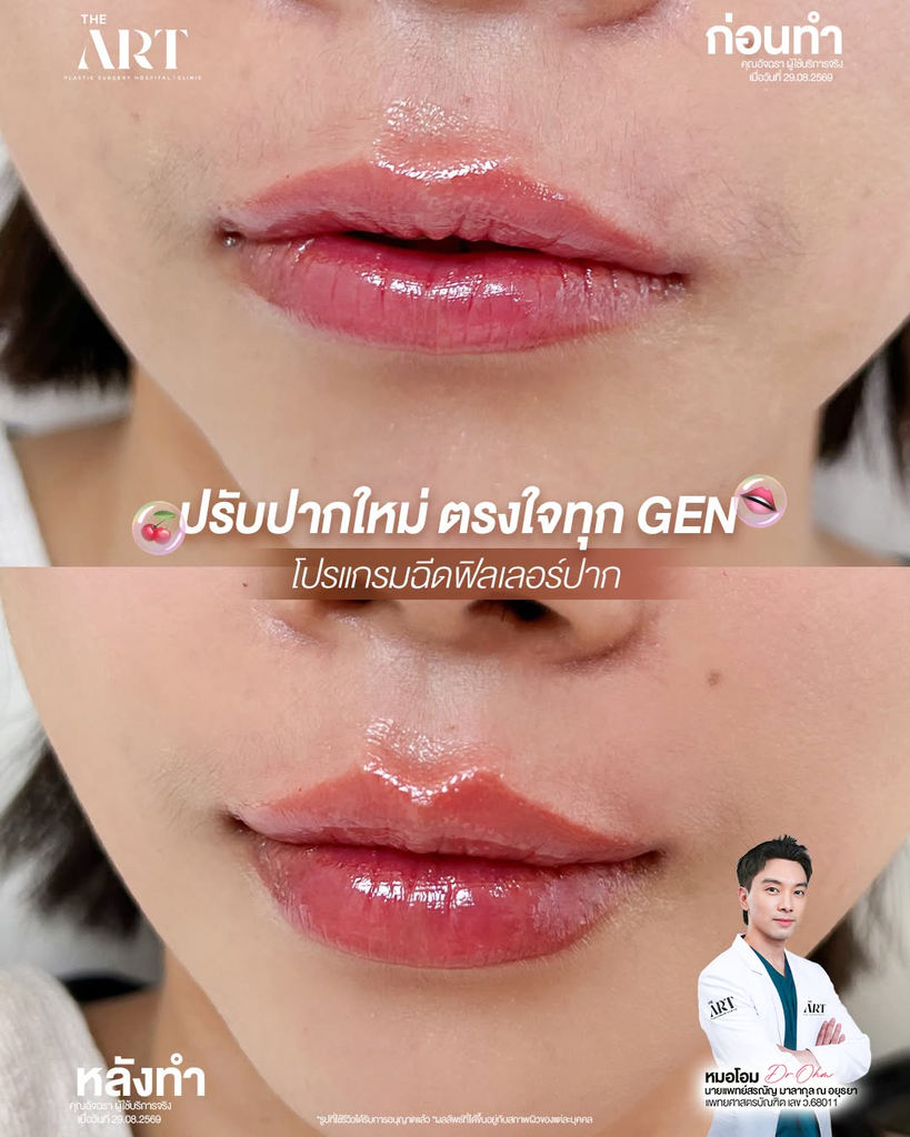 รีวิวฉีดฟิลเลอร์ปากที่ The Art Hospital & Clinic