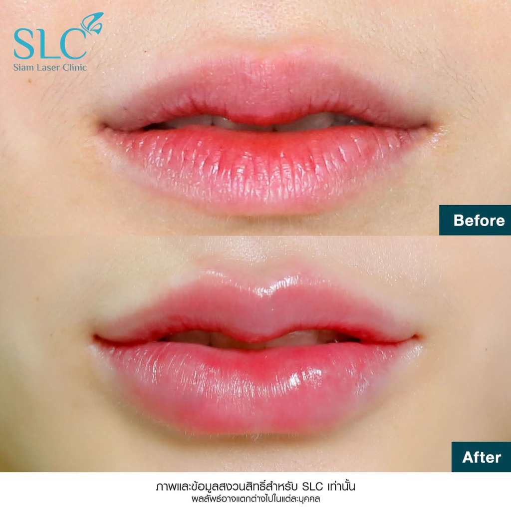 รีวิวฉีดฟิลเลอร์ปากที่ SLC Clinic