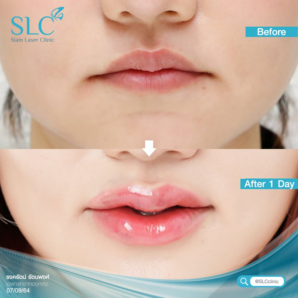 รีวิวฉีดฟิลเลอร์ปากที่ SLC Clinic