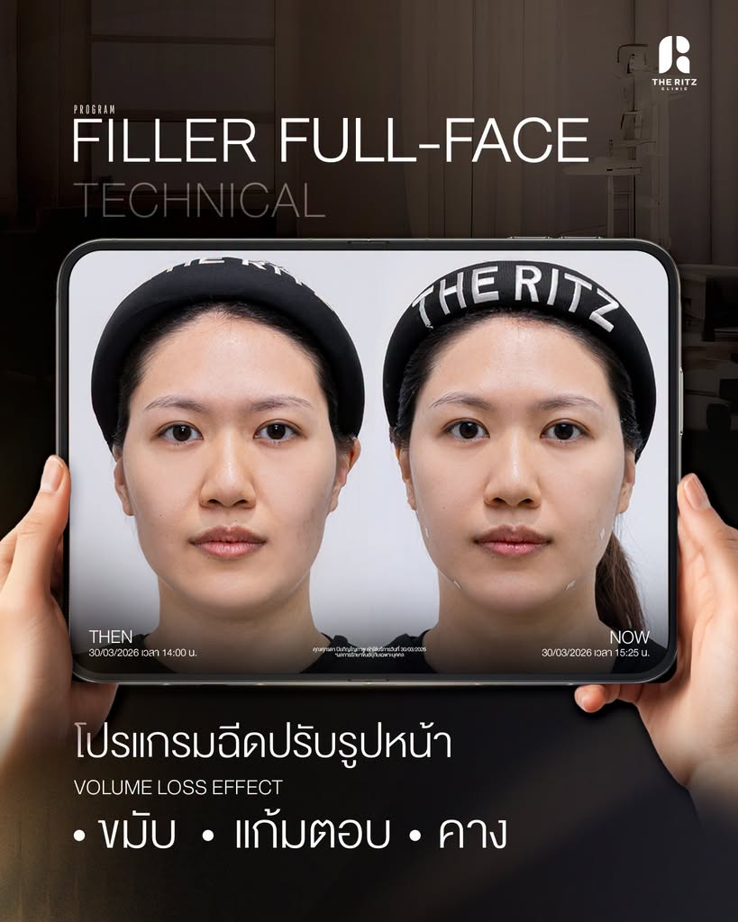 รีวิวฉีดฟิลเลอร์คางที่ The Ritz Clinic