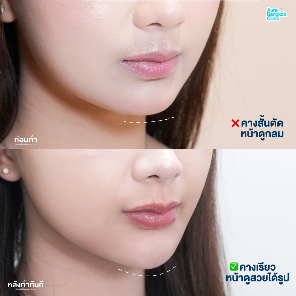 รีวิวฉีดฟิลเลอร์คางที่ Aura Bangkok Clinic