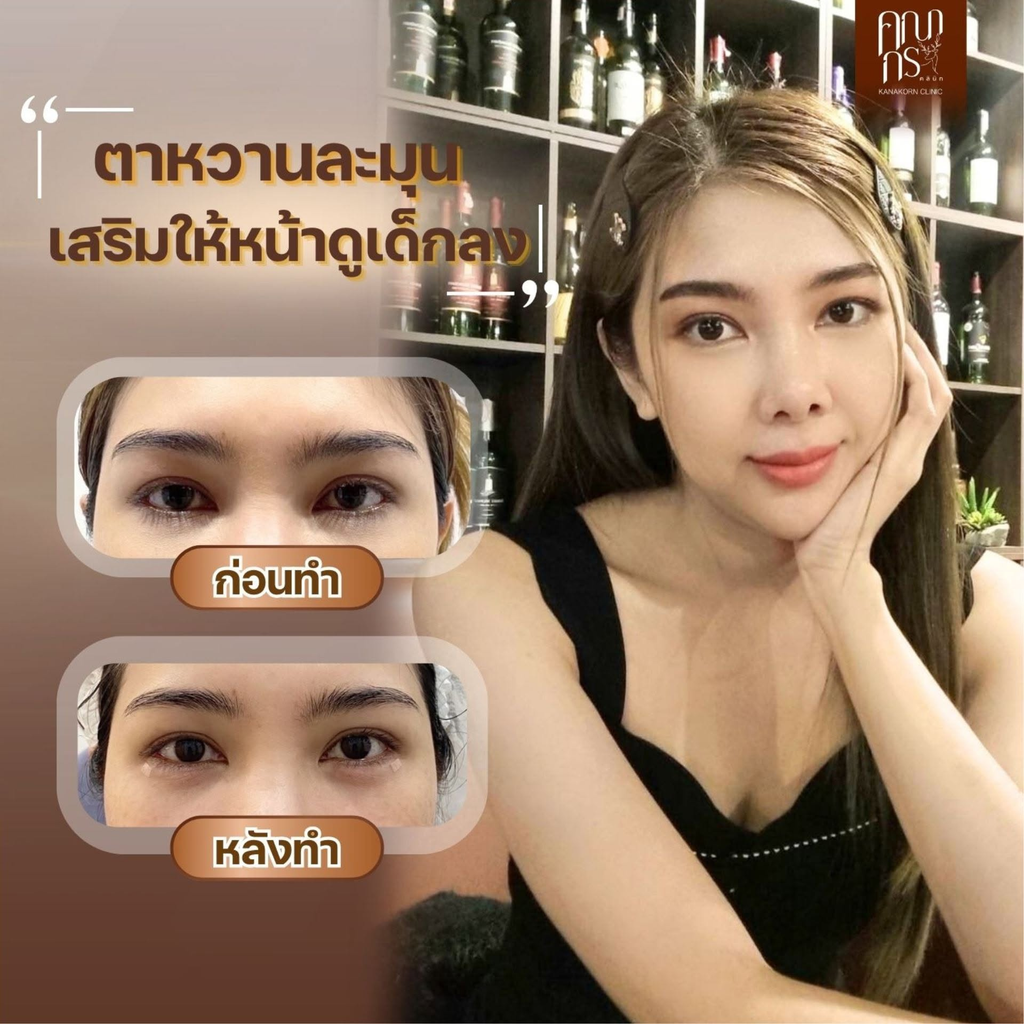 รีวิวฉีดฟิลเลอร์โคราชที่ คณากรคลินิก