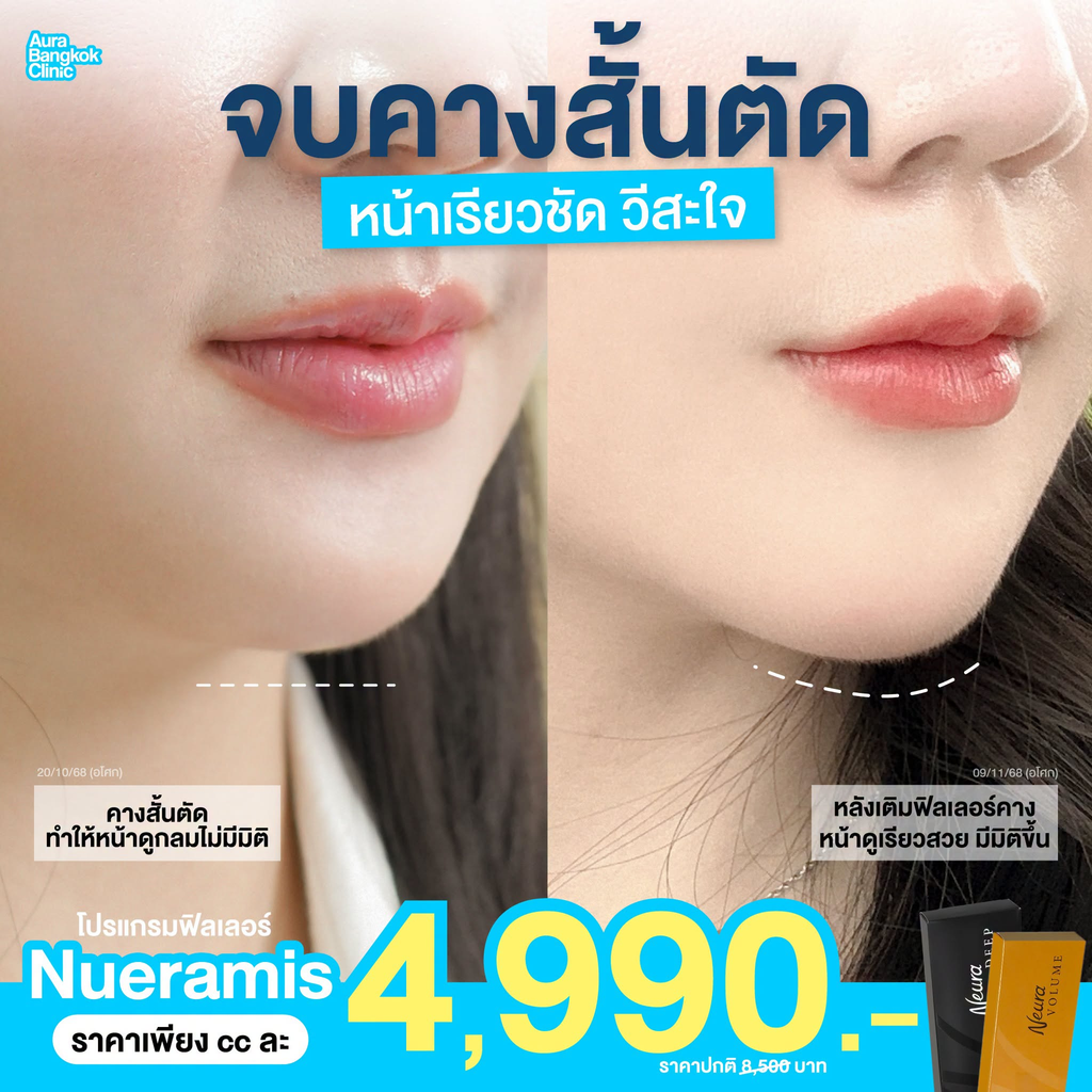 รีวิวฉีดฟิลเลอร์คางที่ Aura Bangkok Clinic