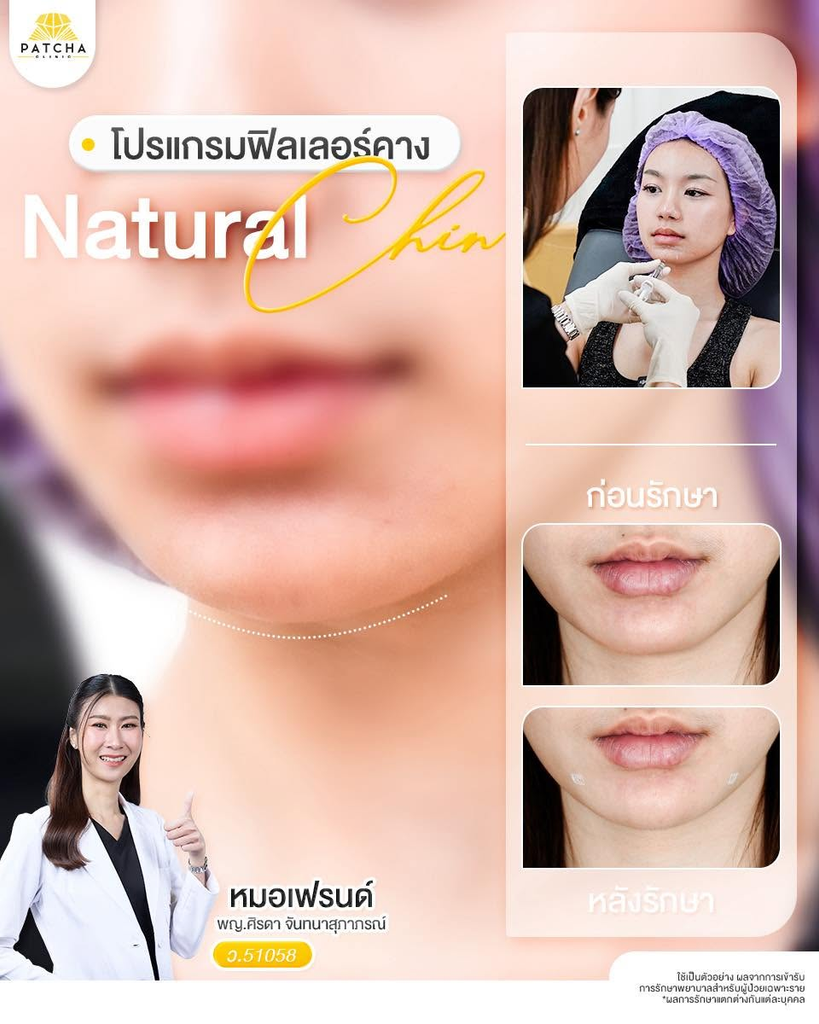 รีวิวฉีดฟิลเลอร์คางที่ Patcha Clinic