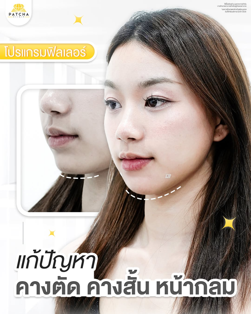 รีวิวฉีดฟิลเลอร์คางที่ Patcha Clinic