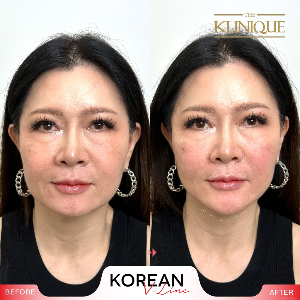 รีวิวฉีดฟิลเลอร์คางที่ THE KLINIQUE