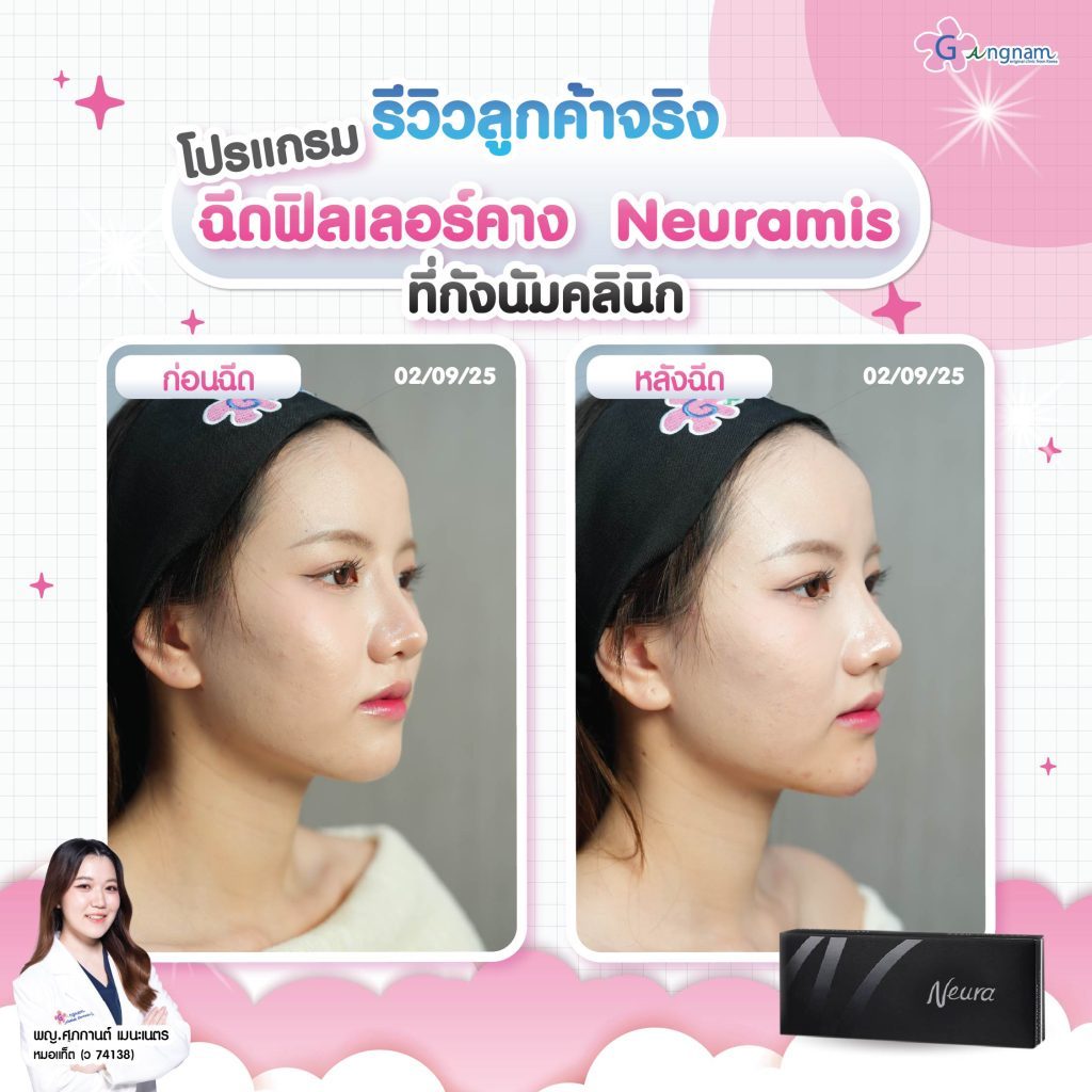 รีวิวฉีดฟิลเลอร์คางที่ Gangnam Clinic