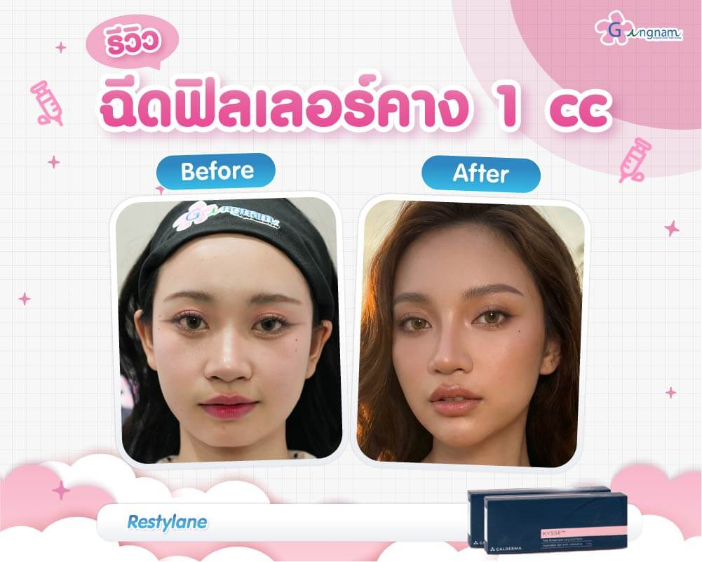 รีวิวฉีดฟิลเลอร์คางที่ Gangnam Clinic