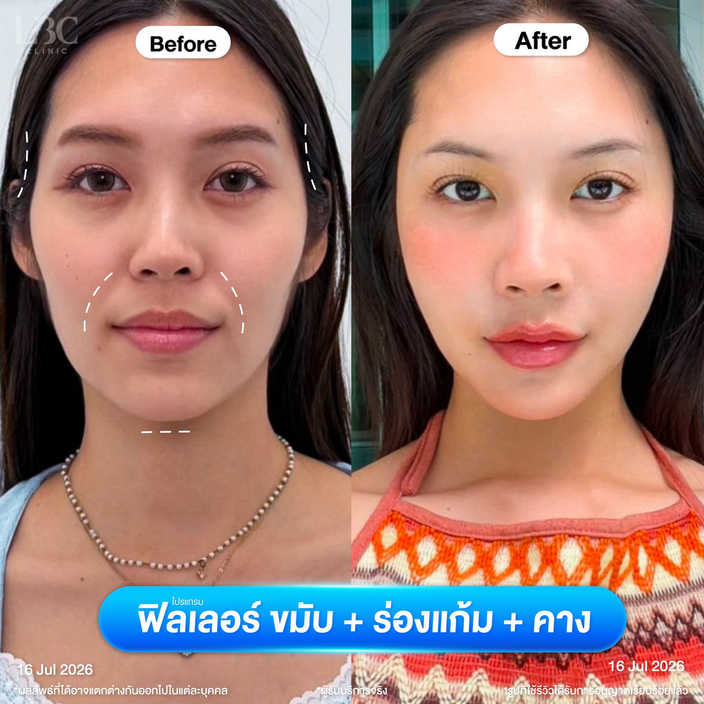 รีวิวฉีดฟิลเลอร์คางที่ LBC Clinic