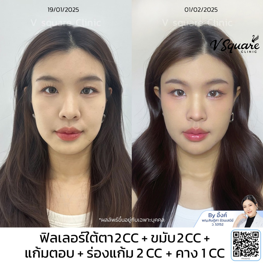 รีวิวฉีดฟิลเลอร์คางที่ V Square Clinic