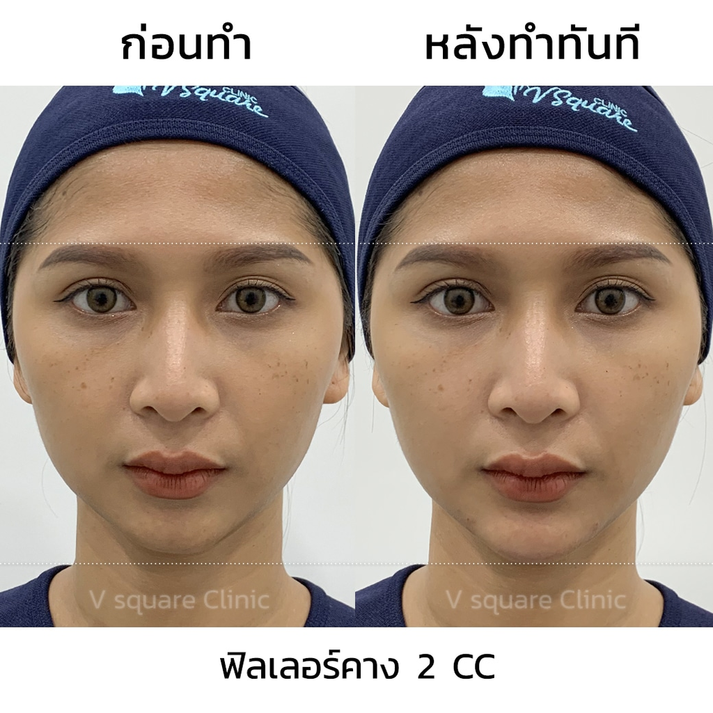 รีวิวฉีดฟิลเลอร์คางที่ V Square Clinic