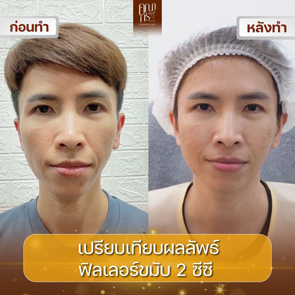 รีวิวฉีดฟิลเลอร์โคราชที่ คณากรคลินิก