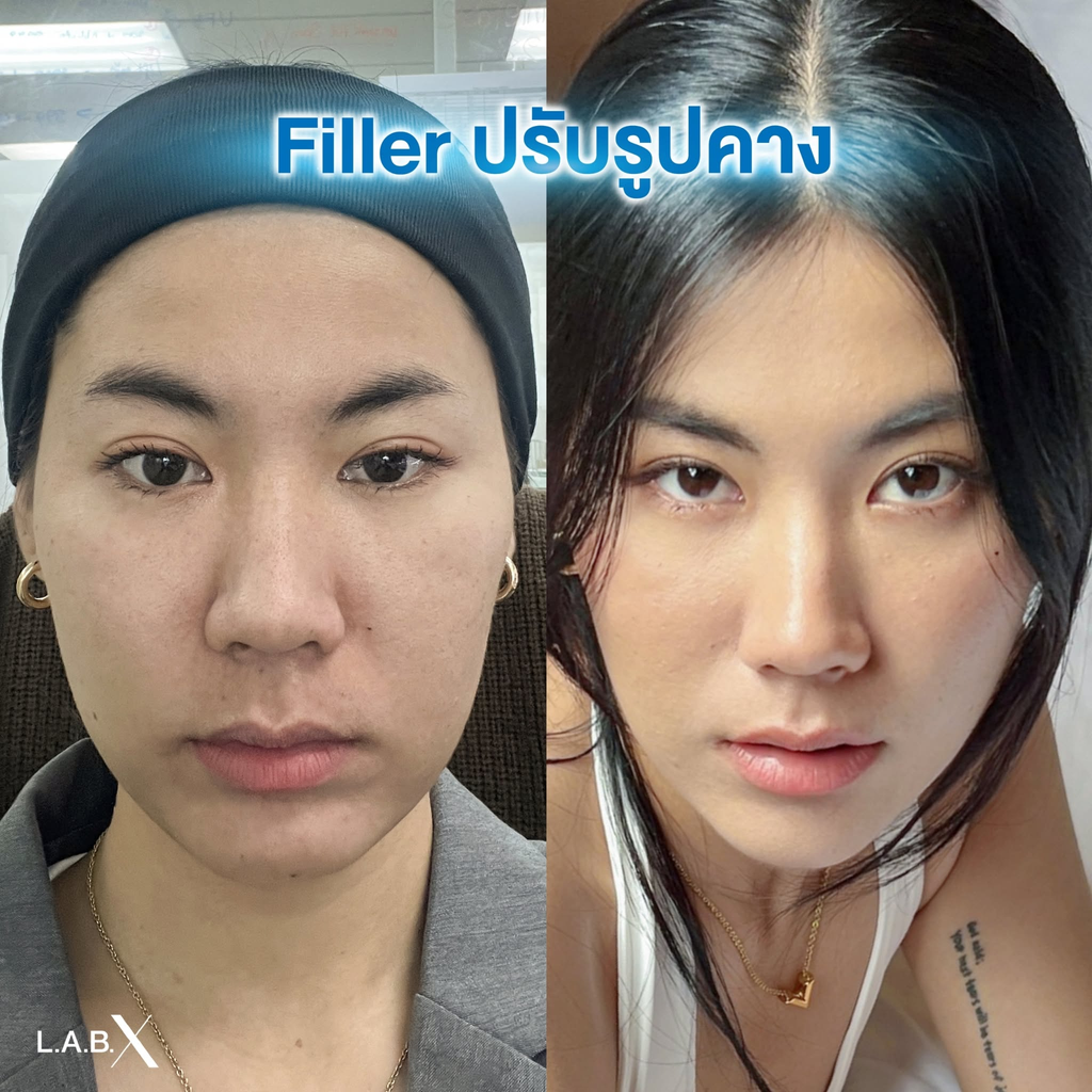 รีวิวฉีดฟิลเลอร์คางที่ LabX Clinic