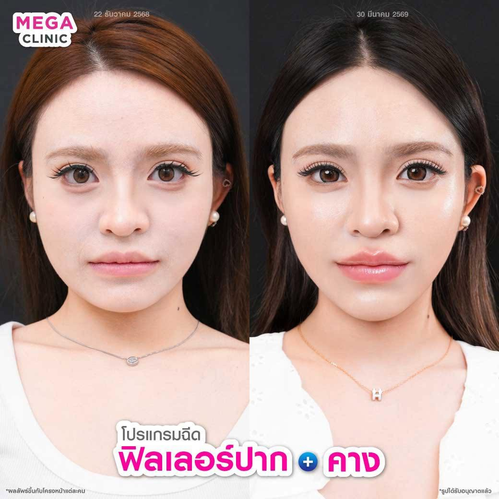 รีวิวฉีดฟิลเลอร์คางที่ Mega Clinic