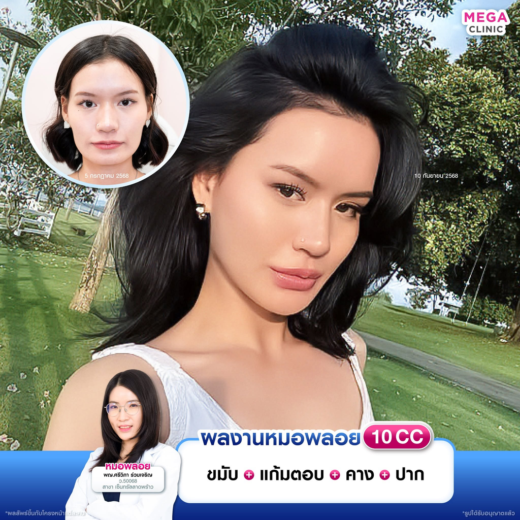 รีวิวฉีดฟิลเลอร์คางที่ Mega Clinic
