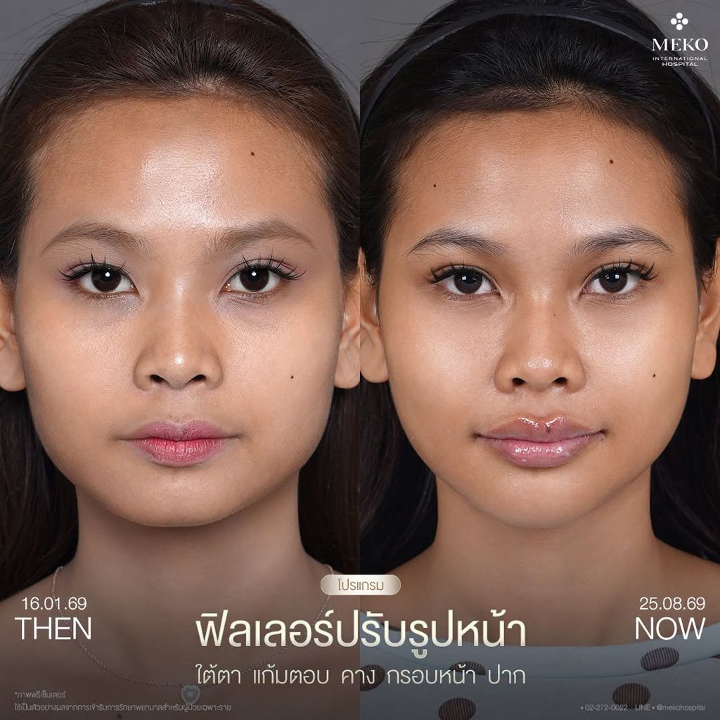 รีวิวฉีดฟิลเลอร์คางที่ Meko Clinic